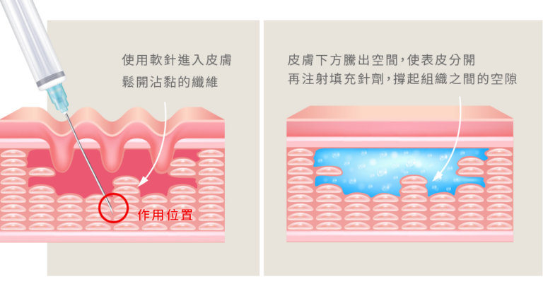 無痛皮下剝離：皮膚科醫師為您解答凹洞疤痕的治療方法 - 木木日安