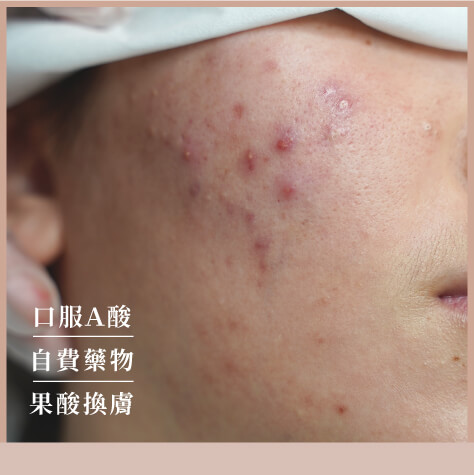 青春痘酒糟特別門診