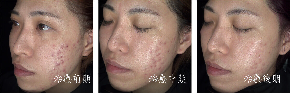 染料雷射案例