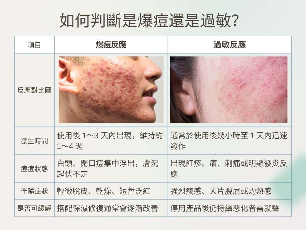 如何判斷是爆痘還是過敏? 爆痘期 vs. 過敏反應對比圖 項目 爆痘反應 過敏反應 發生時間 使用後 1~3 天內出現,維持約 1~4 週 通常於使用後幾小時至 1 天內迅速發作 痘痘狀態 白頭、閉口痘集中浮出,膚況起伏不定 出現紅疹、癢、刺痛或明顯發炎反應 伴隨症狀 輕微脫皮、乾燥、短暫泛紅 強烈癢感、大片脫屑或灼熱感 是否可緩解 搭配保濕修復通常會逐漸改善 停用產品後仍持續惡化者需就醫