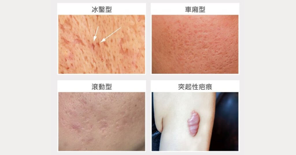 UP雷射:凹洞疤痕、痘疤、凹洞疤 - 木木日安