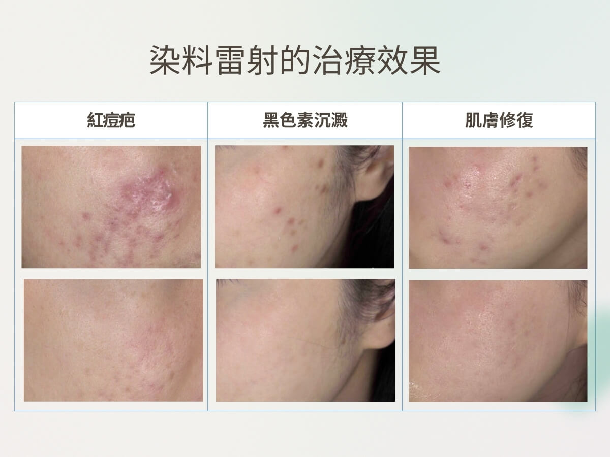 染料雷射的治療效果